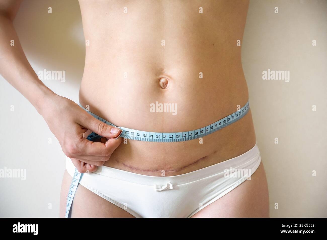 Woman with cesarean section postpartum scar measuring waist after childbirth Stock Photo