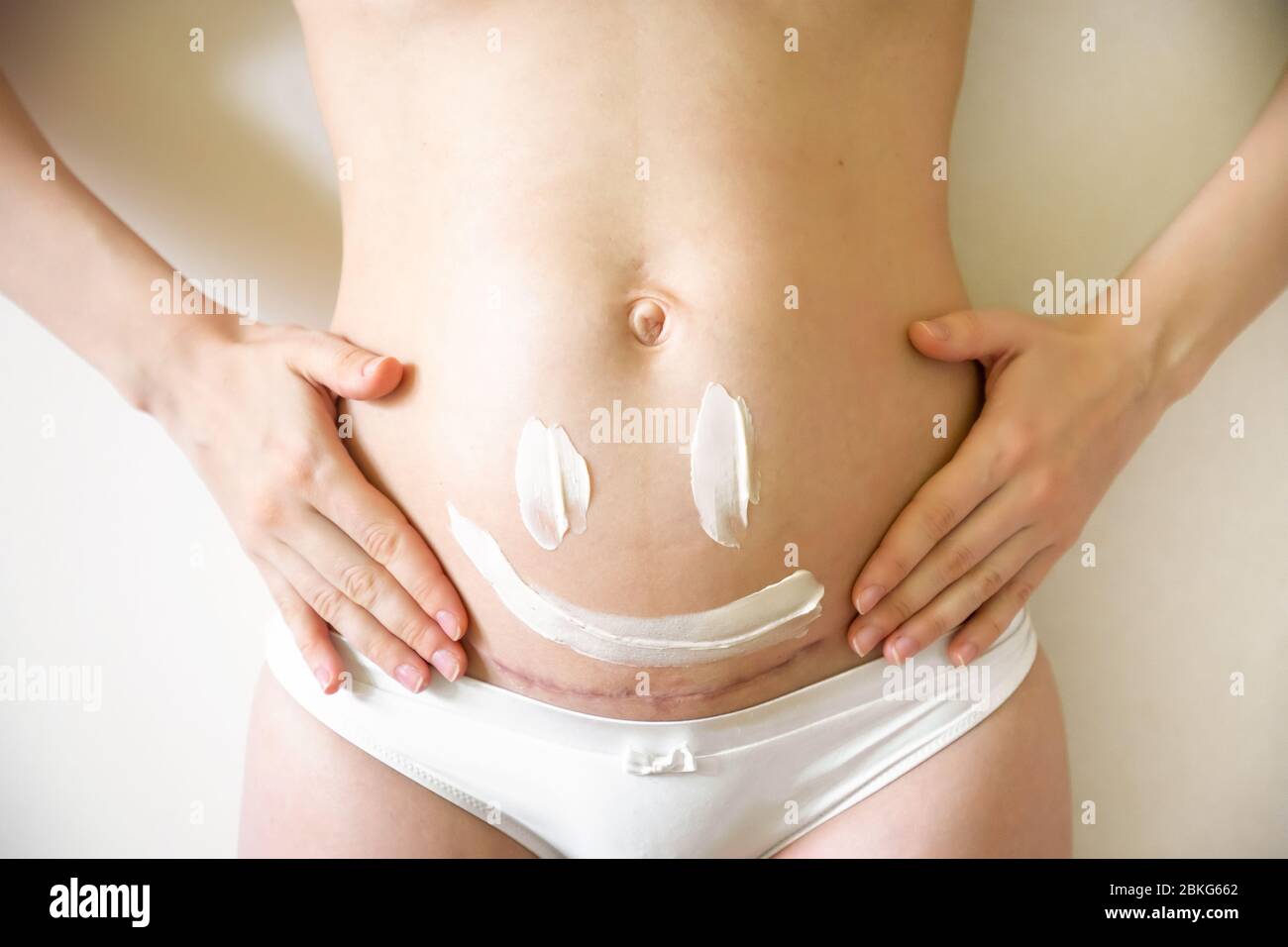 Closeup of woman belly with a scar from a cesarean section and of cosmetic cream on skin Stock Photo