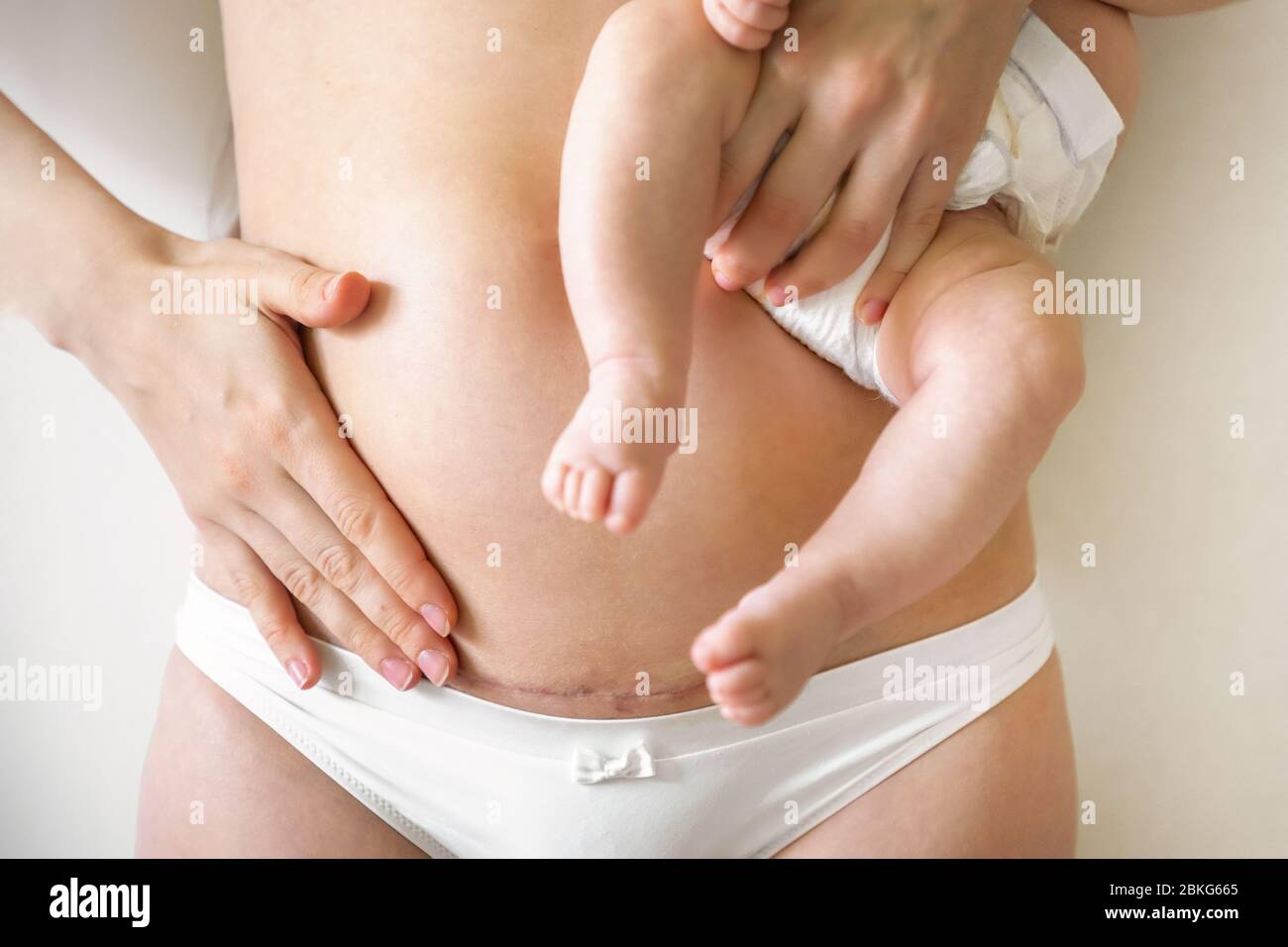 Closeup of woman belly with a scar from a cesarean section. Woman with baby on hand Stock Photo