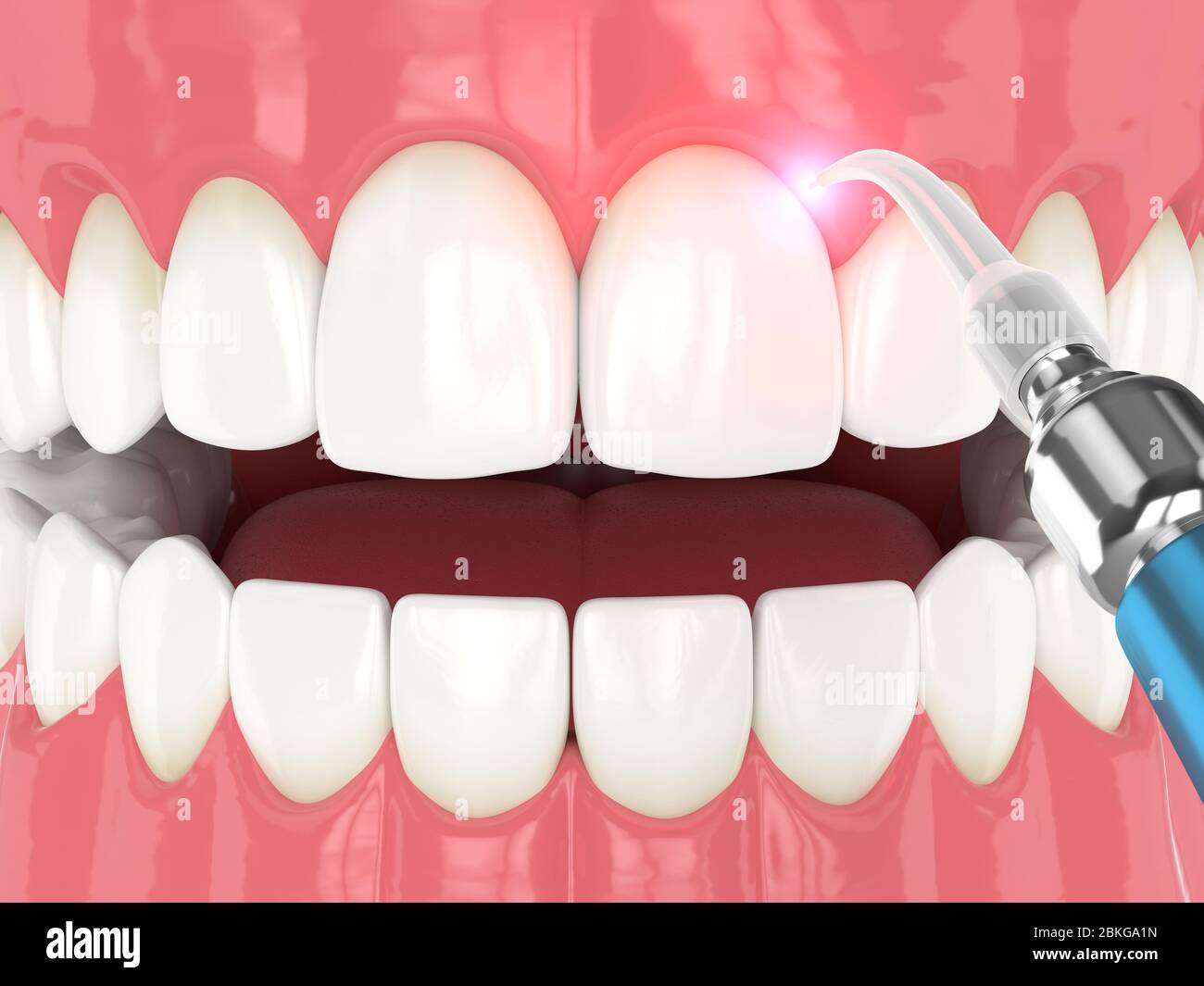 3d render of dental diode laser used to treat gums. The concept of