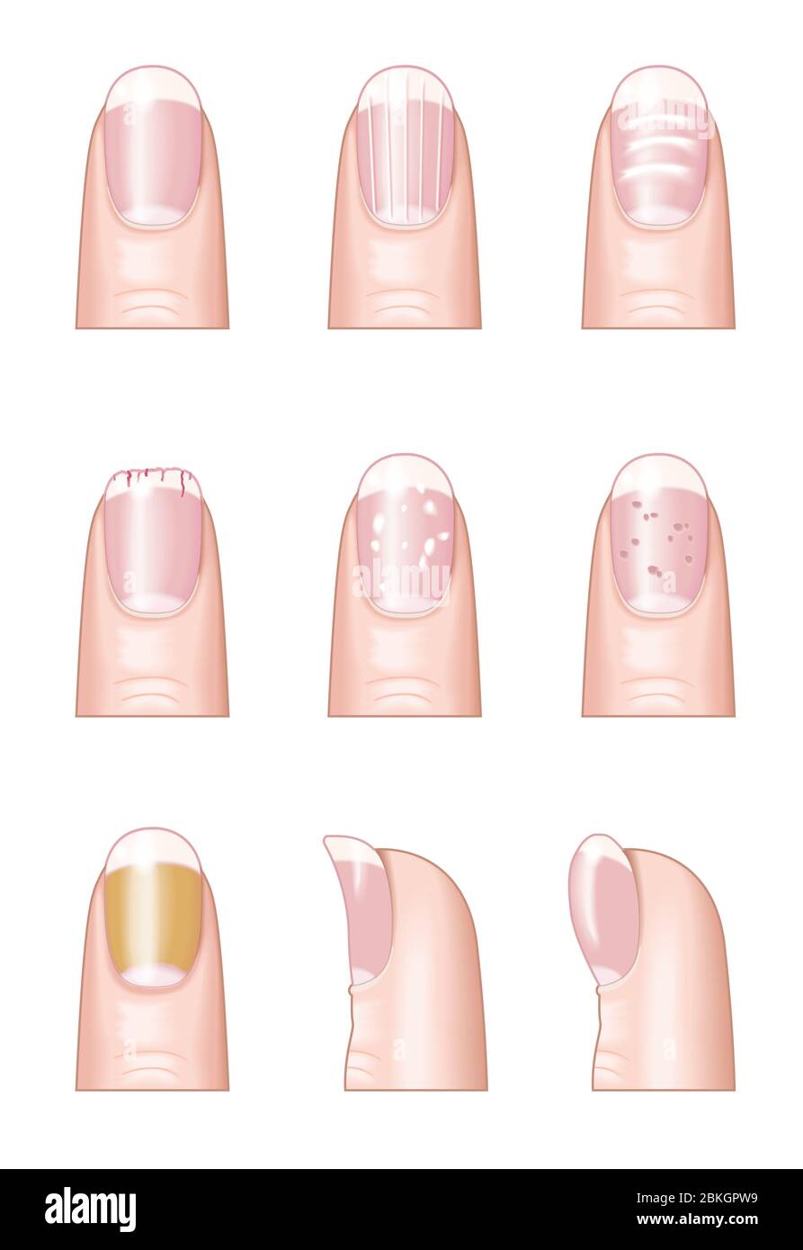 Illustration showing most common nail disorders and diseases: normal  fingernail, cracked or brittle nails, white spots, horizontal bridges  yellow fing Stock Photo - Alamy
