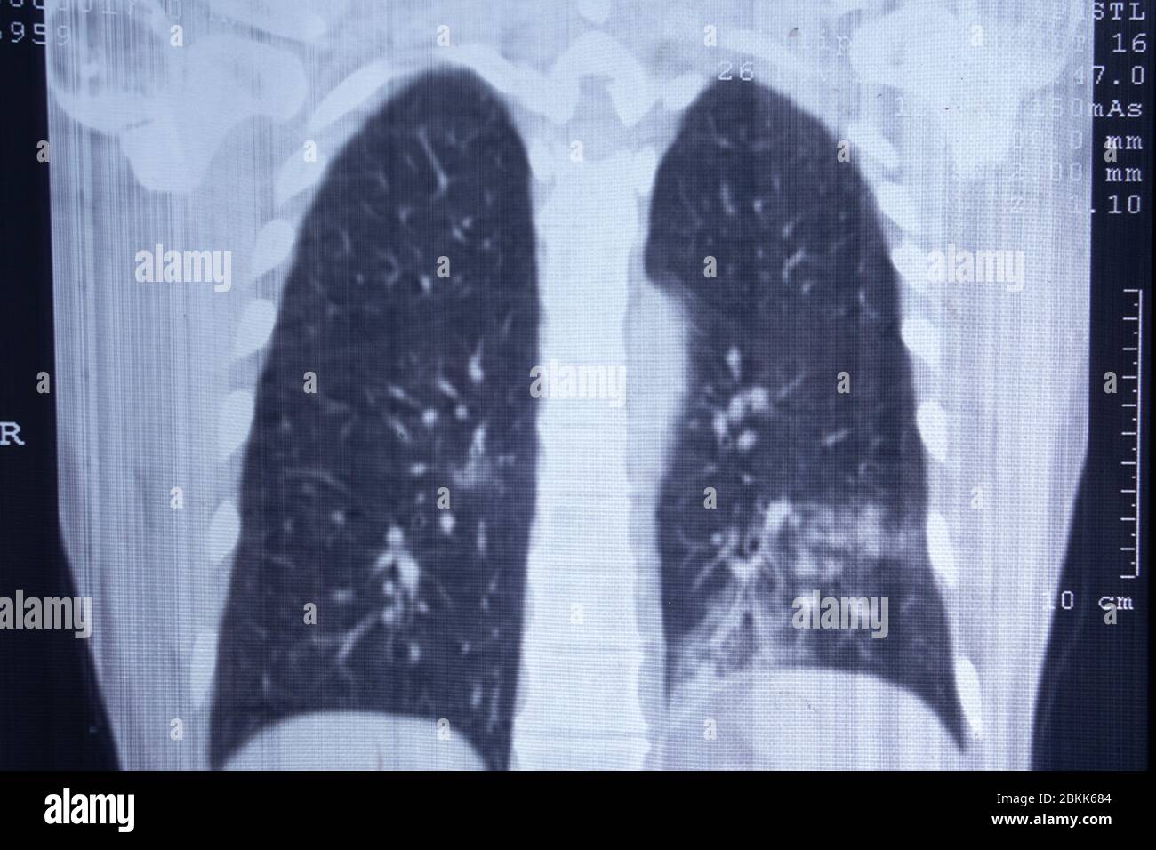 Xray of pneumoniaaffected lungs. CT scan Stock Photo Alamy