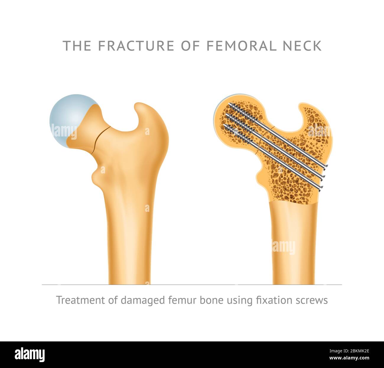 The fracture of femoral neck. Treatment of damaged femur bone neck using fixation screws Stock Vector