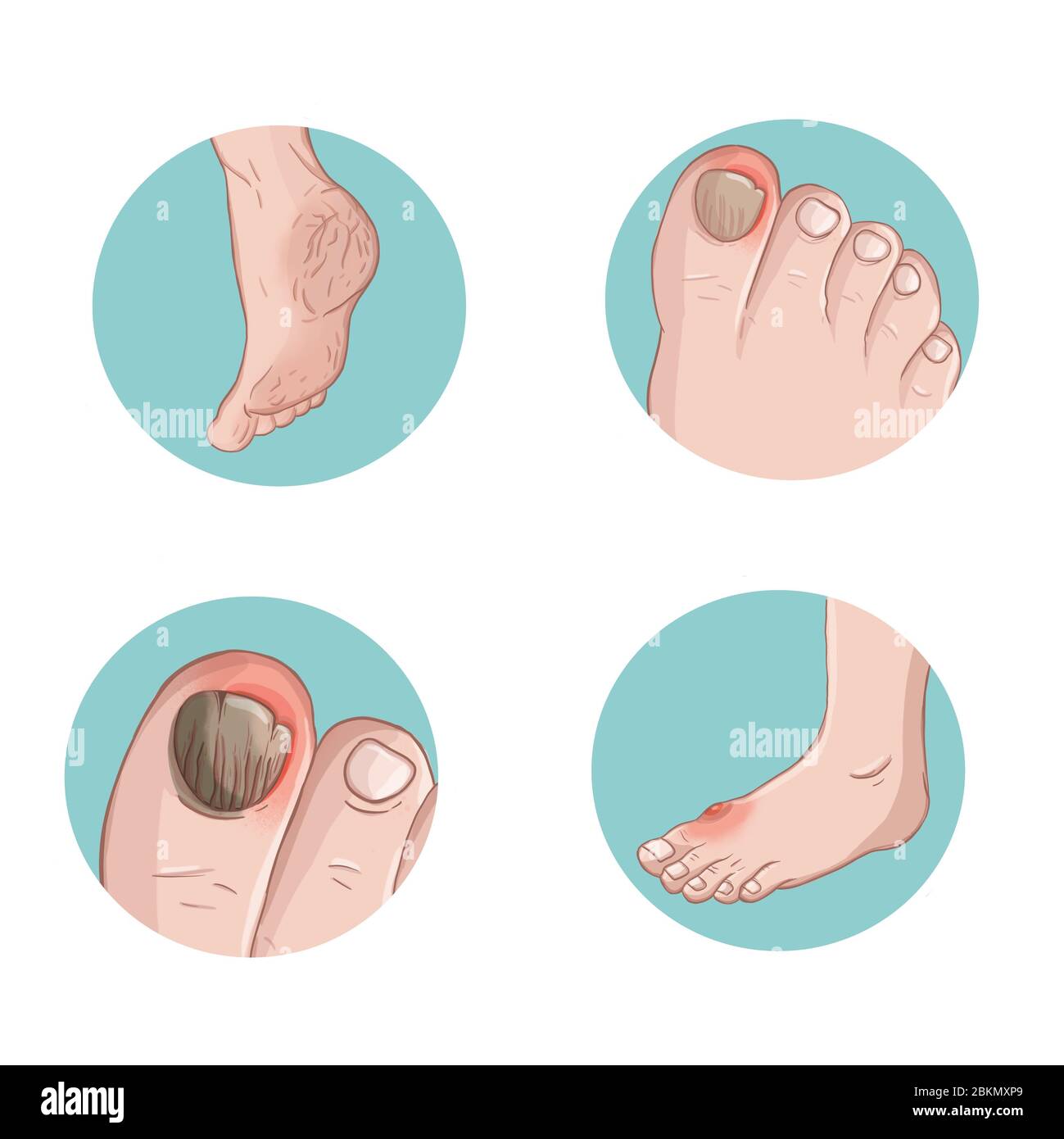 A human leg with sores and problems is depicted in fragments in circles Stock Photo