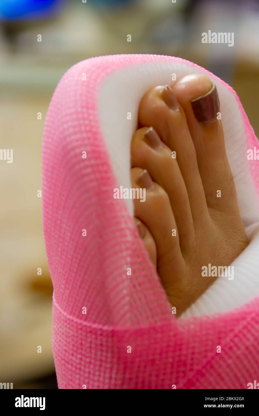 Woman’s foot in a medical pink cast with toes sticking out due to an ankle injury Stock Photo