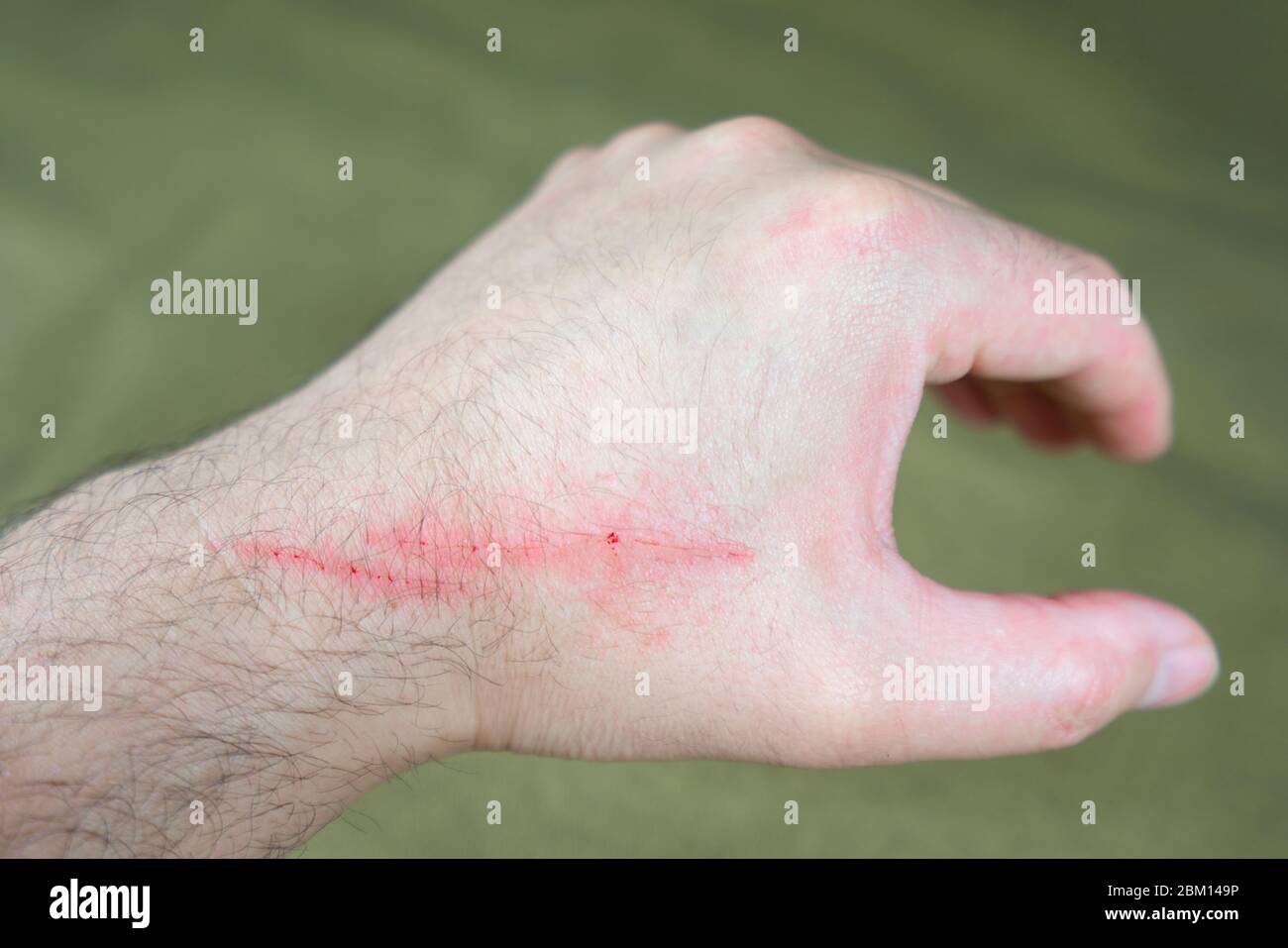 cat scratch
