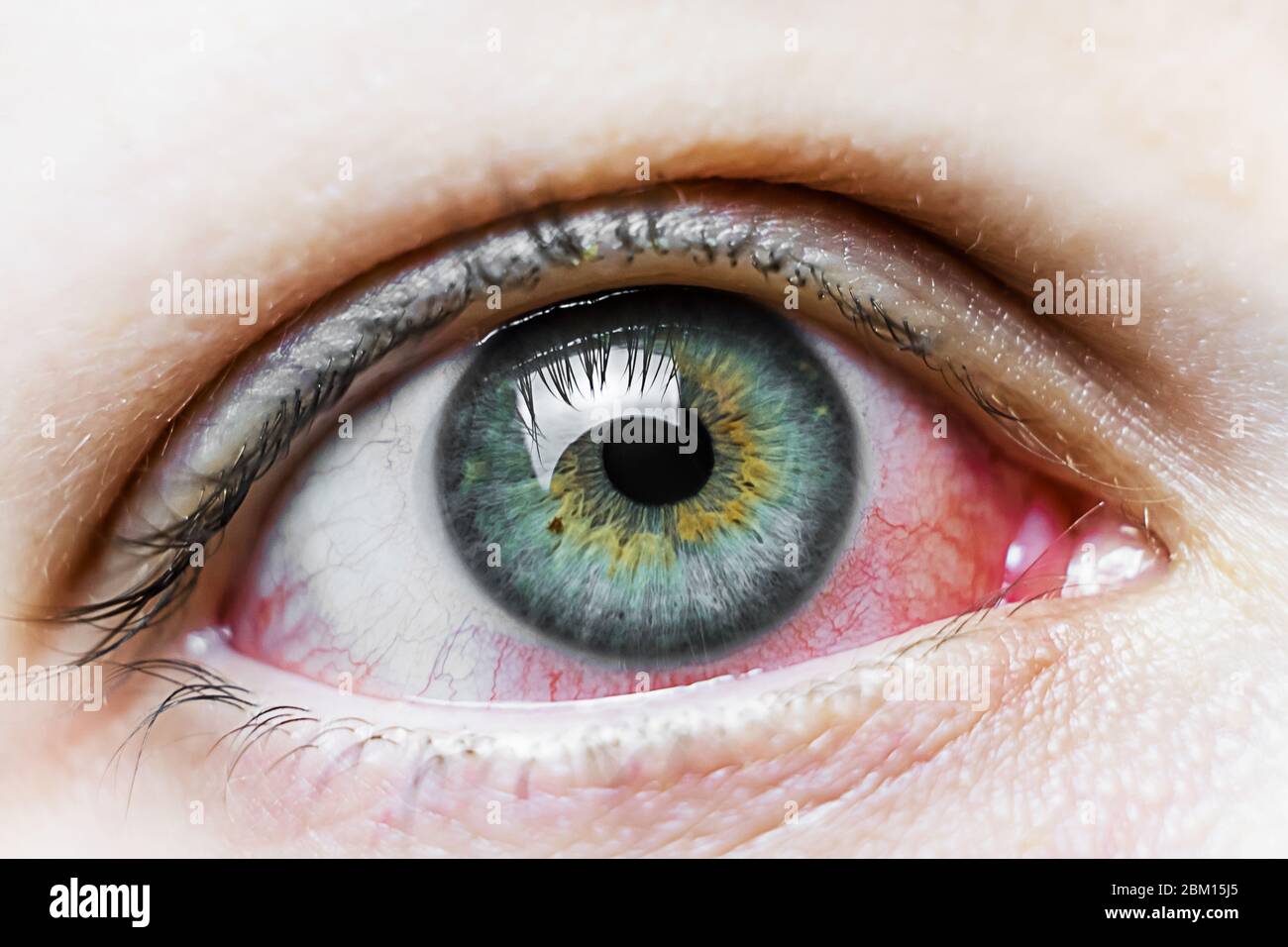 Viral Conjunctivitis High Resolution Stock Photography and Images Alamy