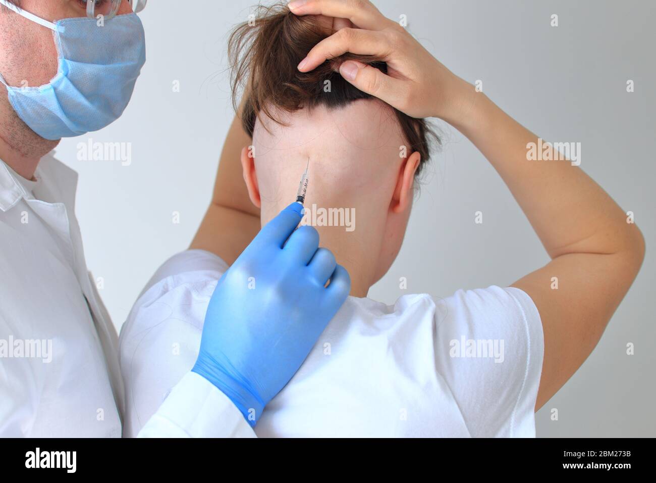 The injections in the bald head of a girl. Real alopecia areata Stock Photo