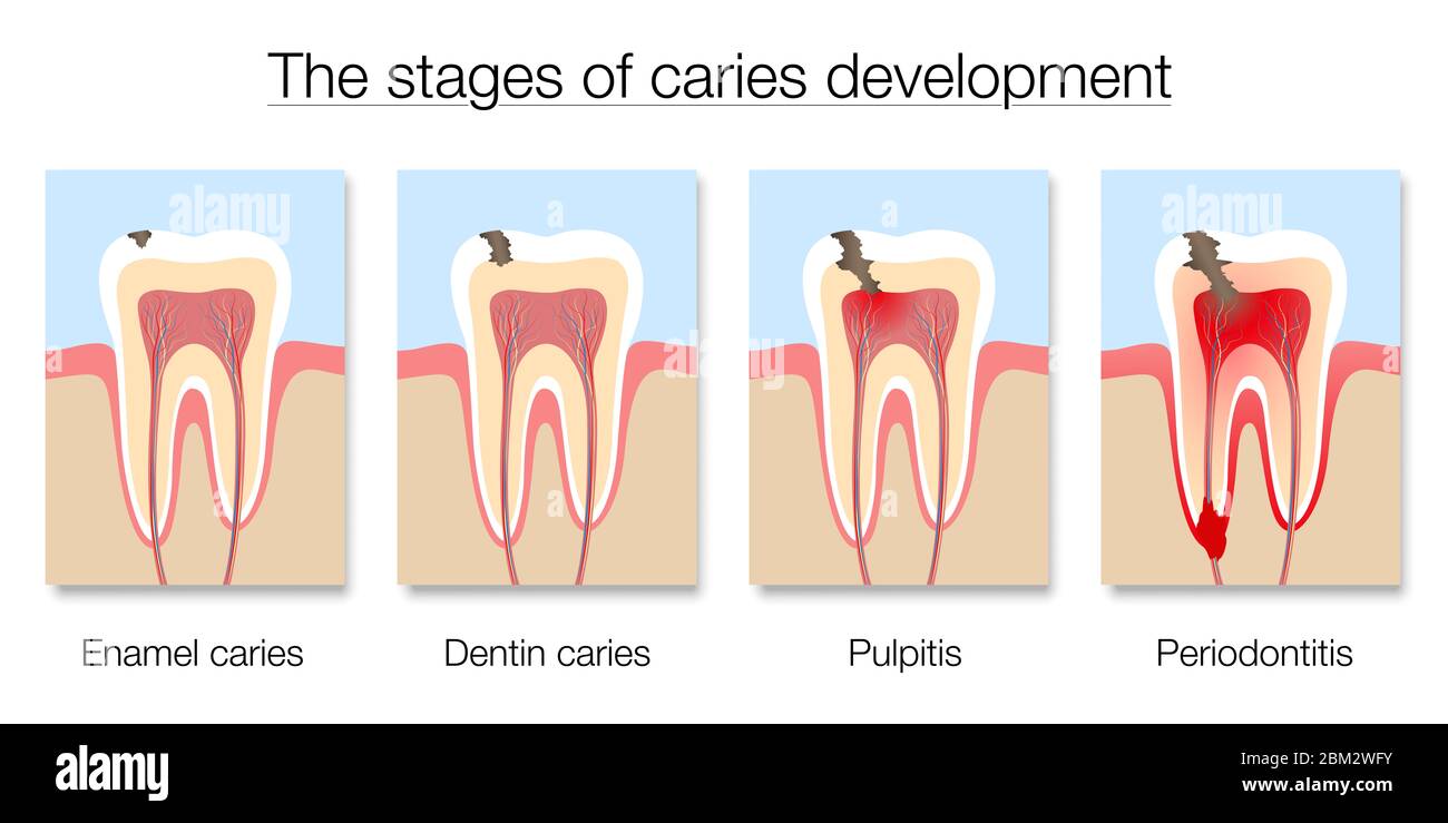 dental caries progression