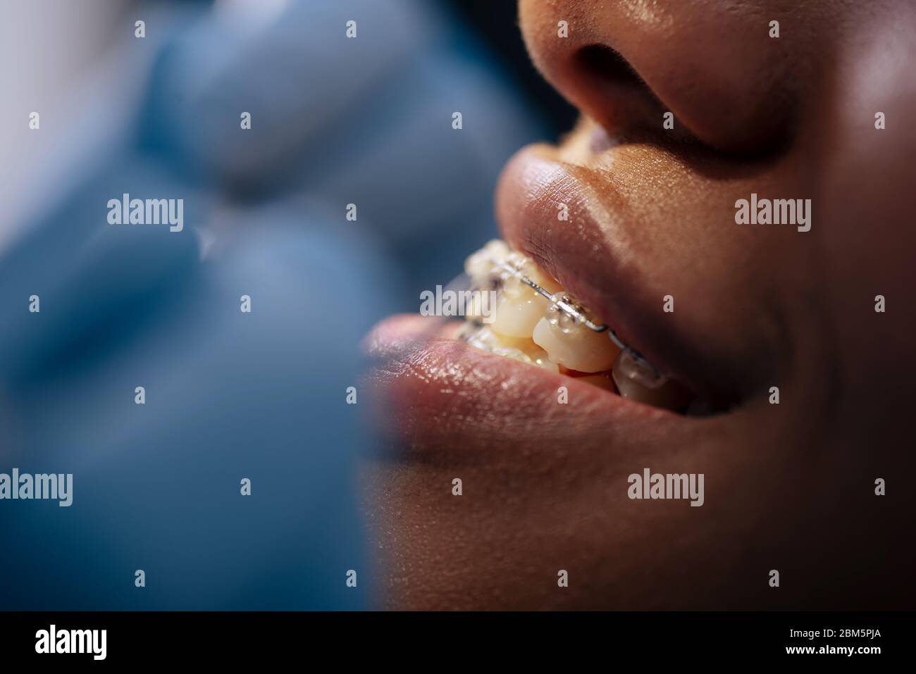 selective focus of smiling african american woman in braces Stock Photo ...