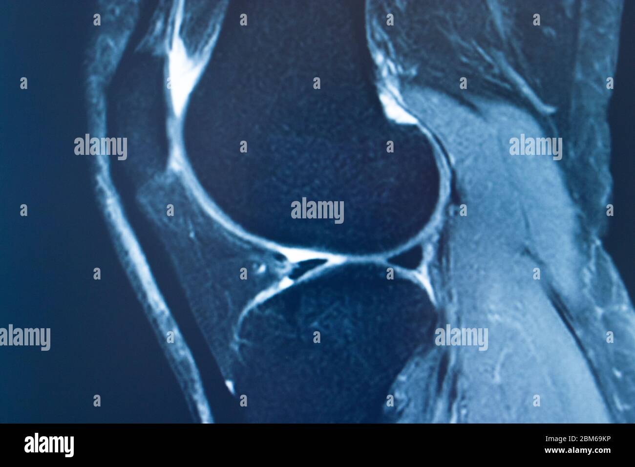 Knee sports injury mri mcl grade 2 tear magnetic resonance imaging ...