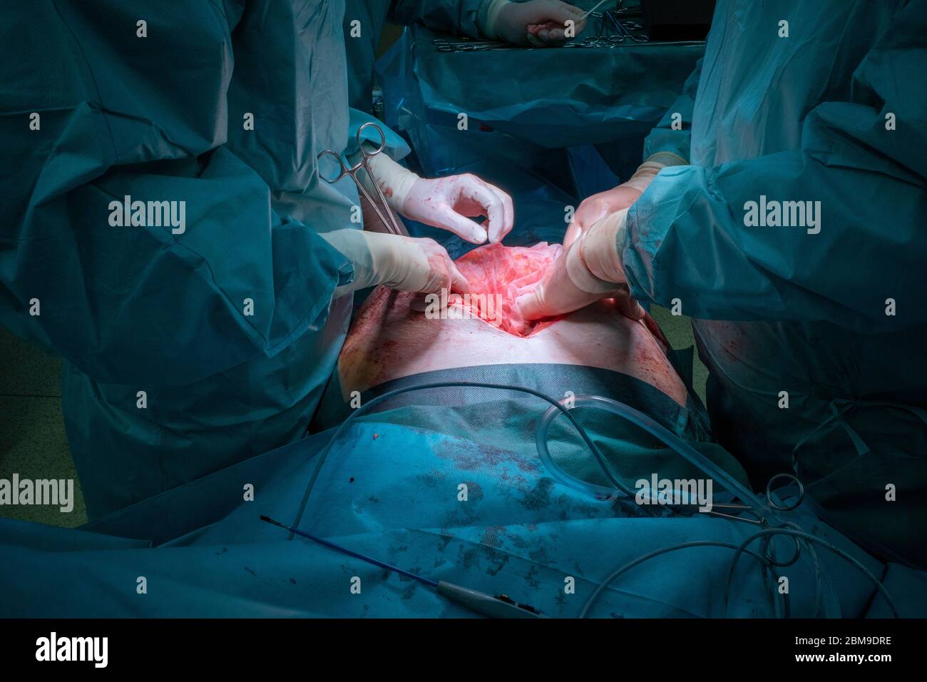 a surgical team performs a surgical abdominal operation Stock Photo