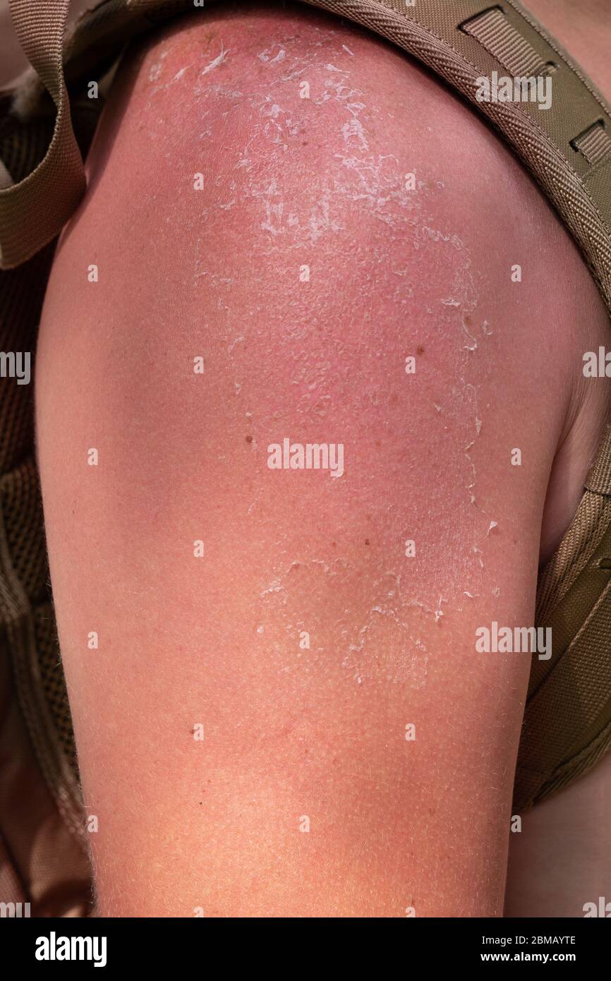 hand in the shoulder area affected by  sunburn. Red, inflamed, peeling skin. Stock Photo