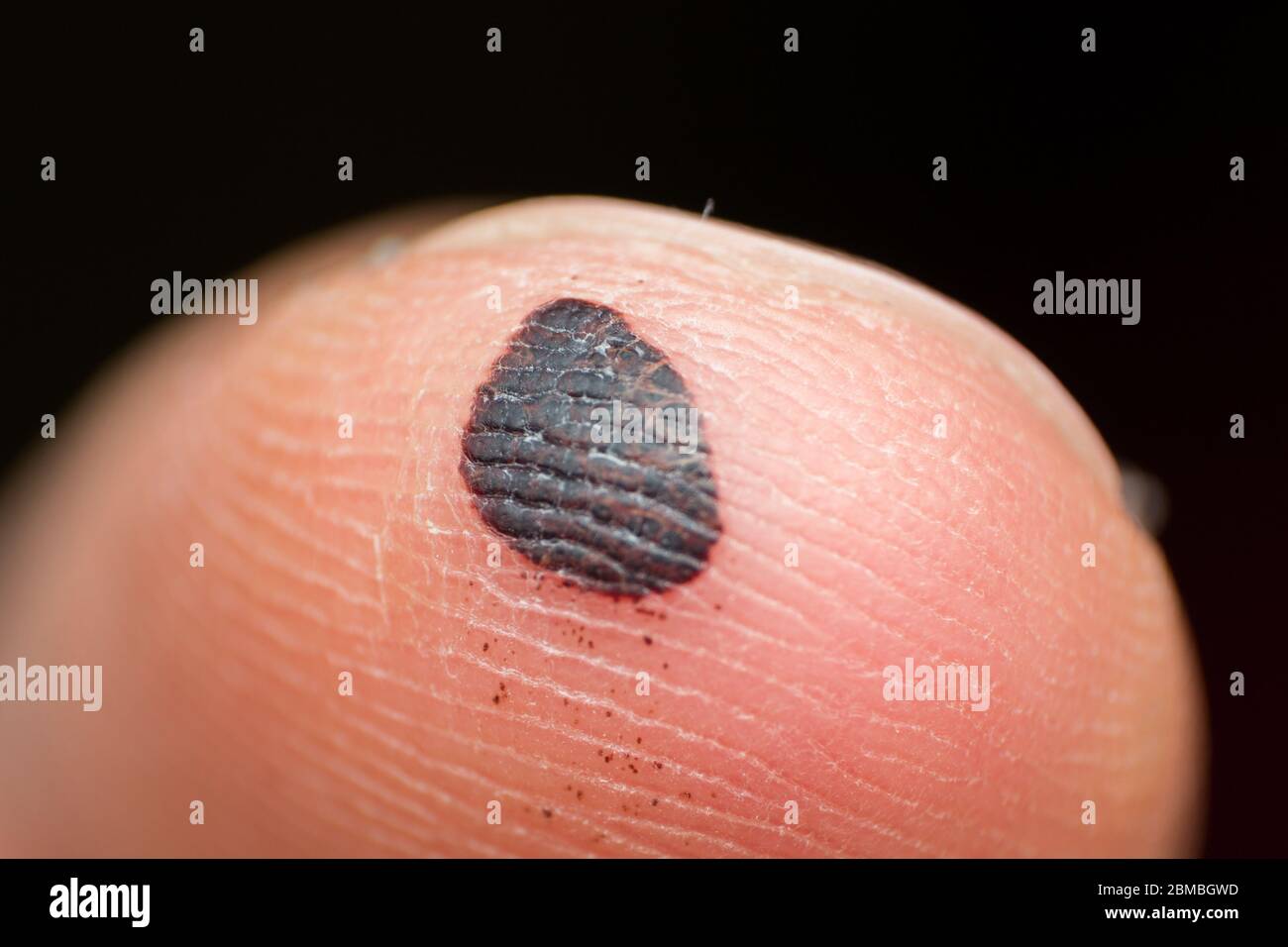 What Does A Blood Blister Look Like Wholesale Cheapest Save 41