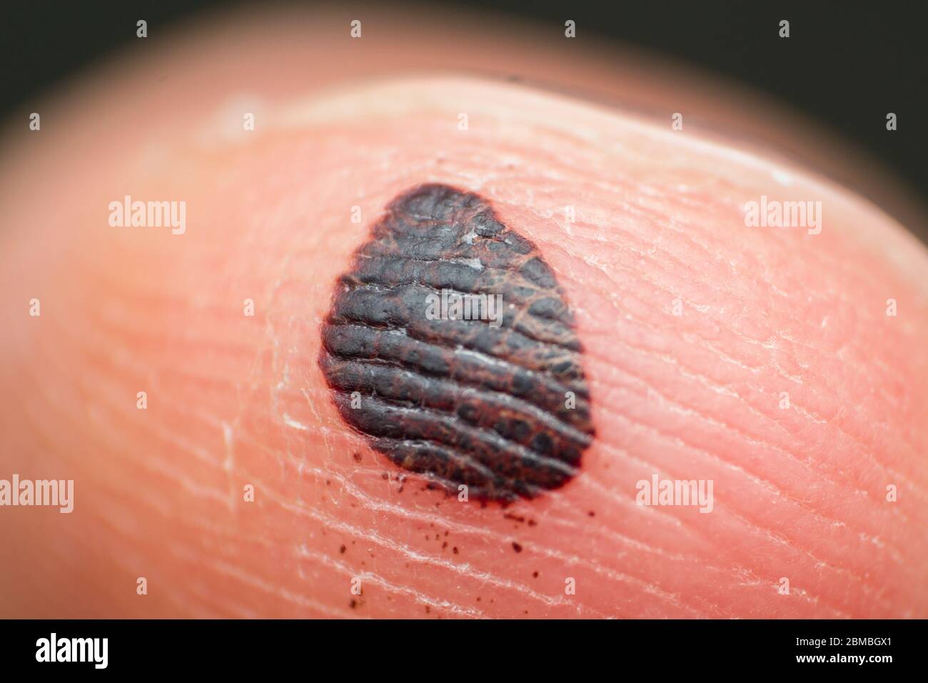 Subcutaneous hematoma close up. Finger injury trauma cause by hitting