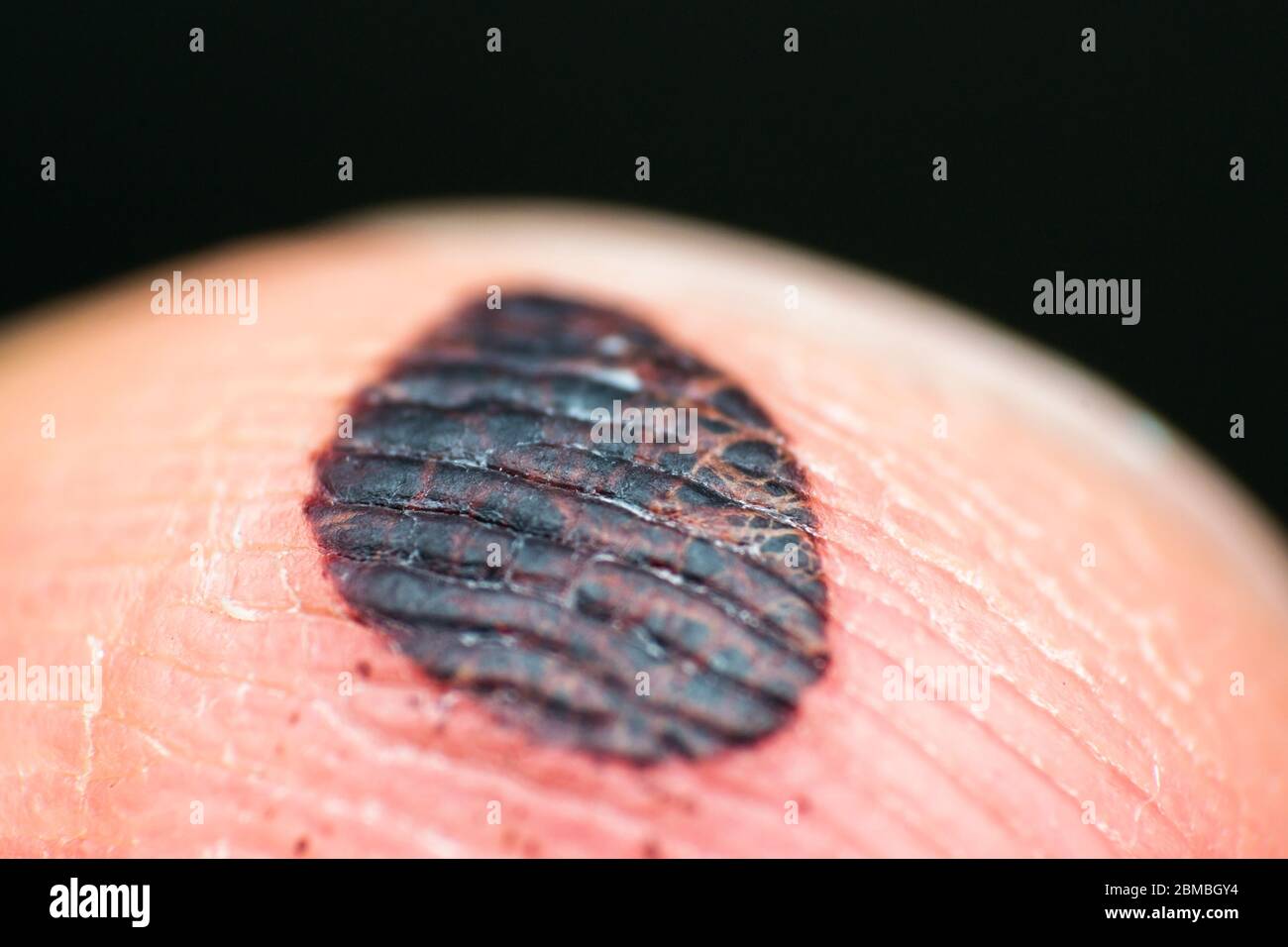 Blood blister hires stock photography and images Alamy