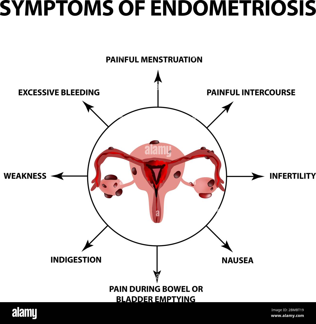 Symptoms of endometriosis. The uterus ovaries structure. Infographics. Vector illustration on isolated background Stock Vector