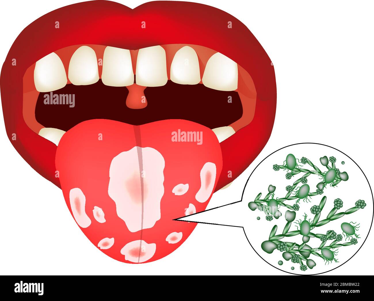 Oral thrush. Candidiasis on the tongue. Fungus in the mouth. Infographics. Vector illustration on isolated background. Stock Vector