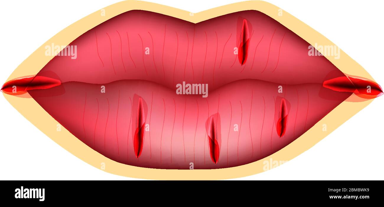 Cracks in the lips. Dry chapped lips. Wounds in the corners of the