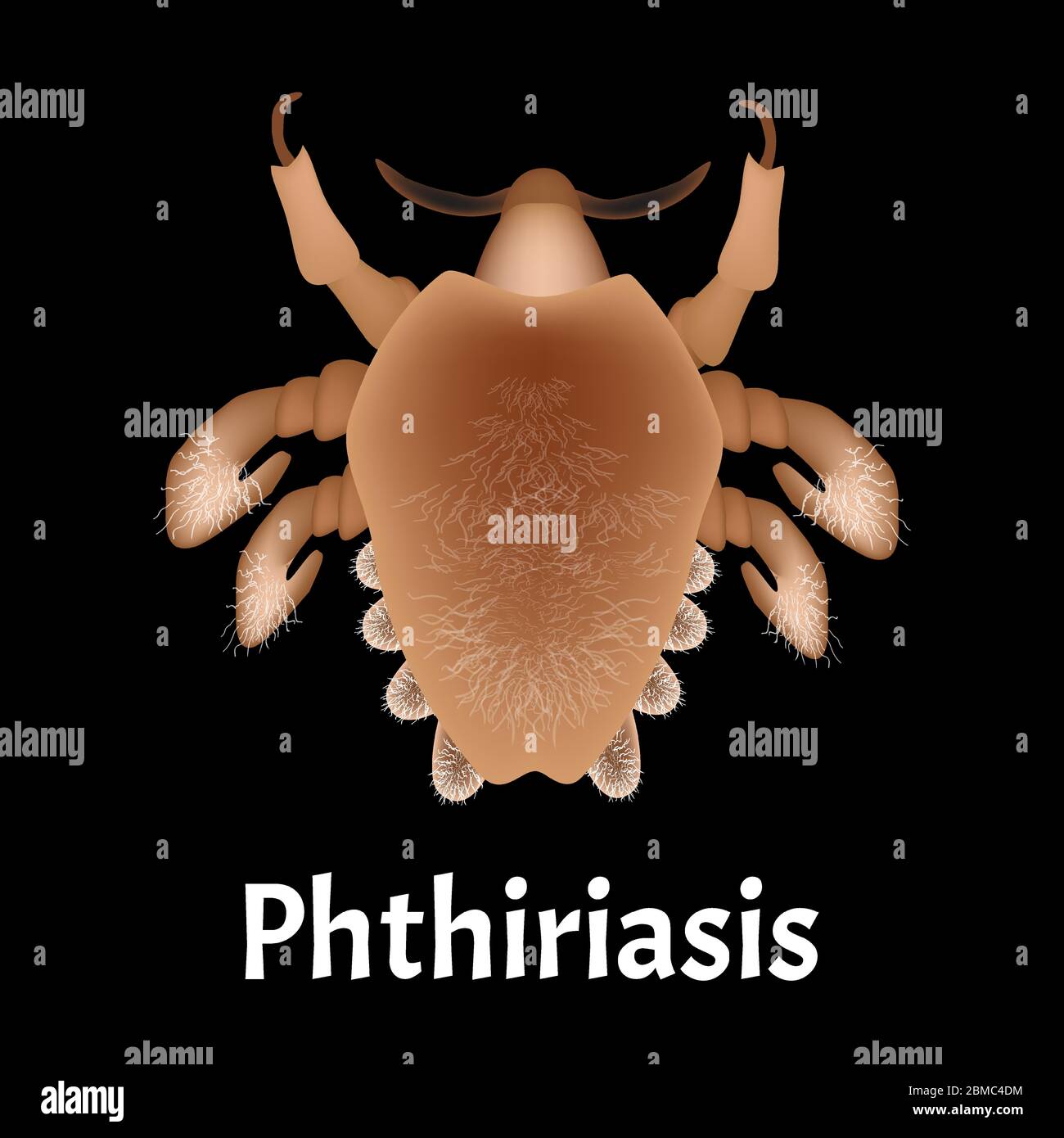 Parasitic diseases of Phthiriasis. Pediculosis pubis. Pubic lice structure. Sexually transmitted diseases. Infographics. Vector illustration on Stock Vector