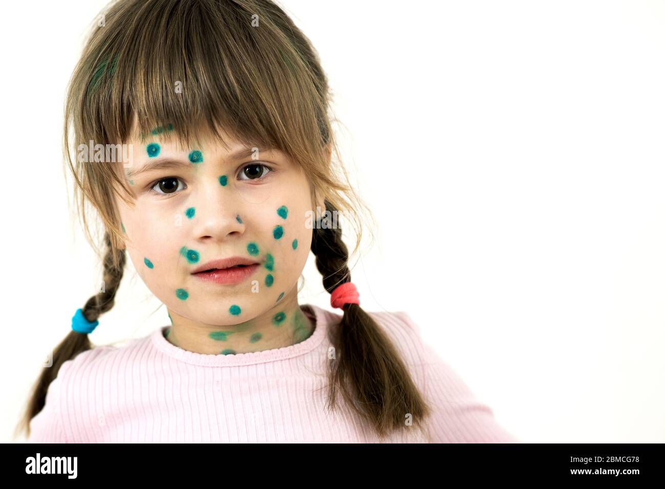 Child girl covered with green rashes on face ill with chickenpox, measles or rubella virus. Stock Photo