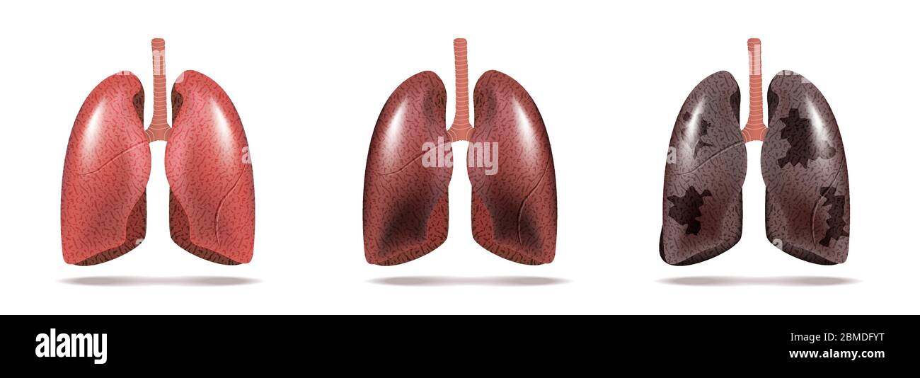 Normal lung and lung cancer illustration. Vector Stock Vector Image ...