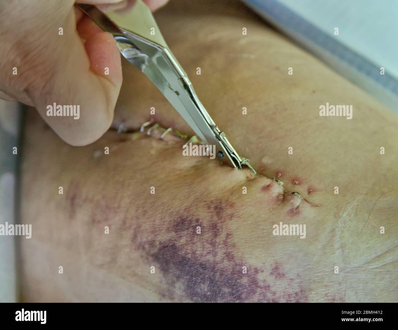 Incision, nurse removing surgical stainless steel staples,  total right hip  arthroplasty surgery. Stock Photo