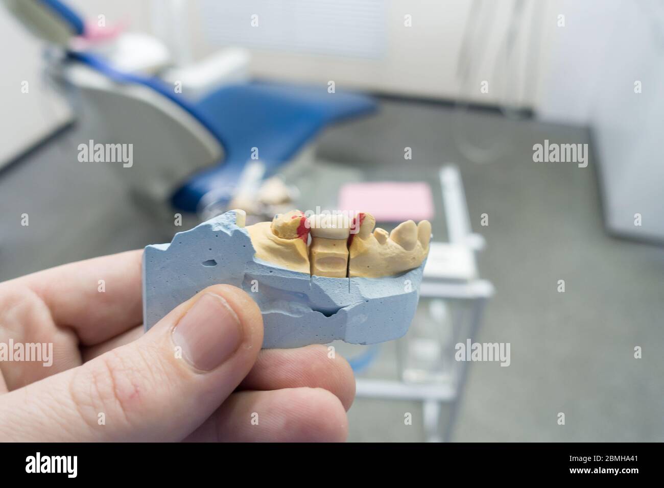 dental ceramic-metal crowns on a plaster model in the doctor’s hands Stock Photo