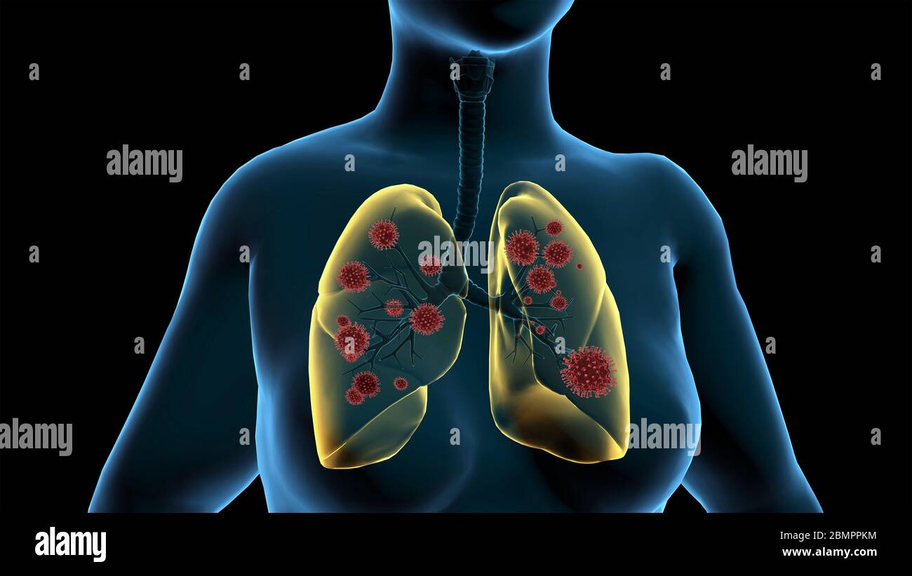Computer illustration showing the lungs of a woman infected with virus particles. Stock Photo
