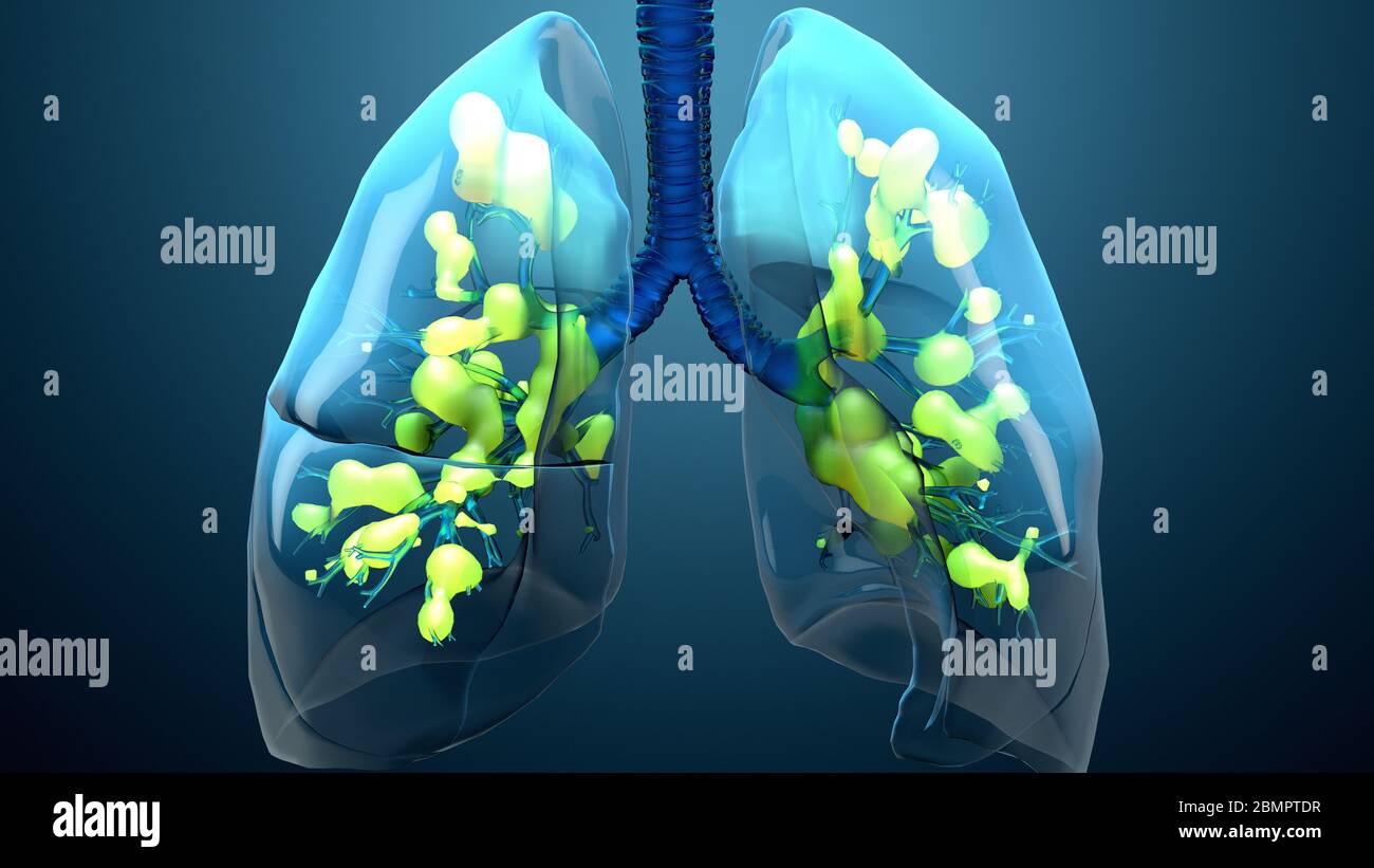 Damaged lungs hires stock photography and images Alamy