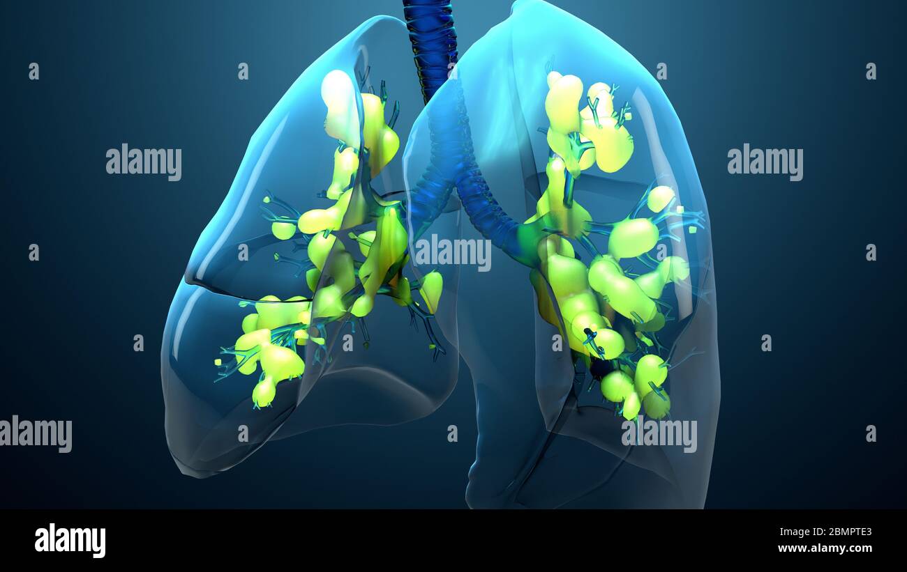 Damaged lungs hires stock photography and images Alamy