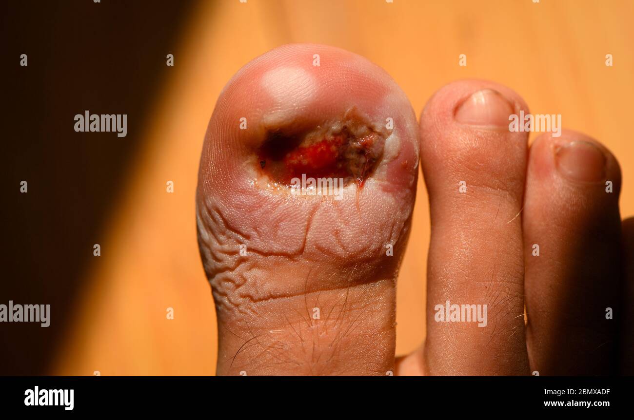A toe after having an operation to remove a in-grown toenail removing dressing to wash and treat and let dry out before reapplying dressing. Stock Photo