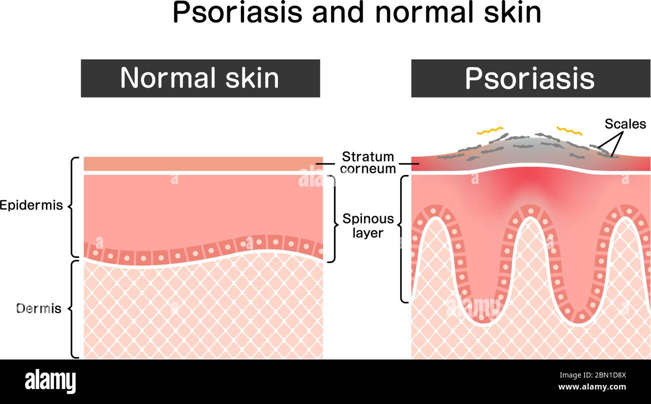 Cross section of psoriasis and normal skin / flat vector illustration ...