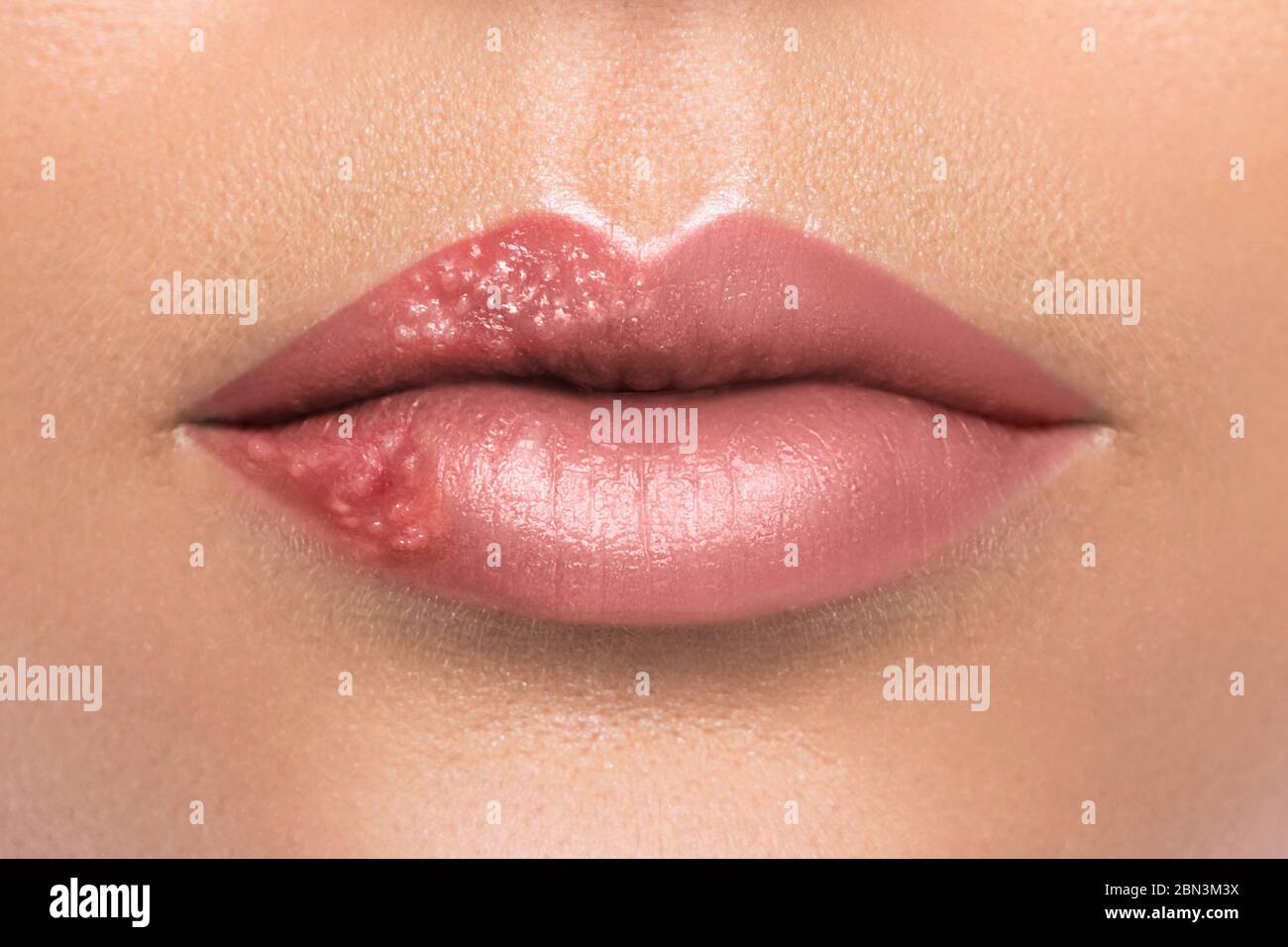 Herpes simplex female hires stock photography and images Alamy