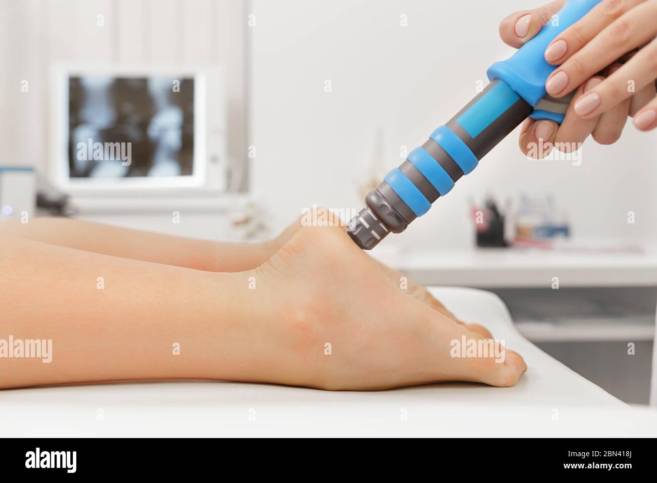 Extracorporeal Shockwave Therapy ESWT.Effective non-surgical treatment.Physical therapy for plantarfascitis with shock waves.Pain relief Stock Photo