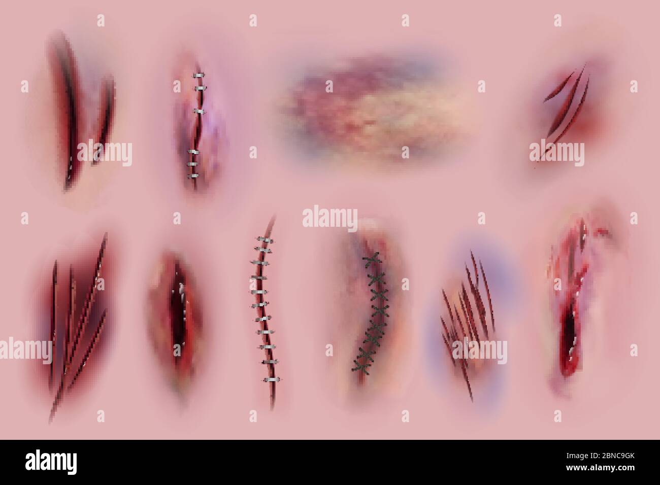 Bloody wounds. Scars, surgical stitches and bruis, skin cuts. Bloody wound textures vector isolated set. Illustration of scar skin cut, surgical stitch Stock Vector