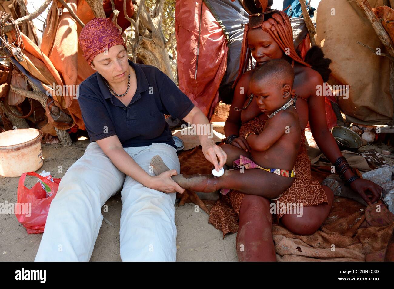 Caucasian woman applying antibiotic ointment to a burned himba child. Burns from the open fires or embers are among the most common injuries, especial Stock Photo