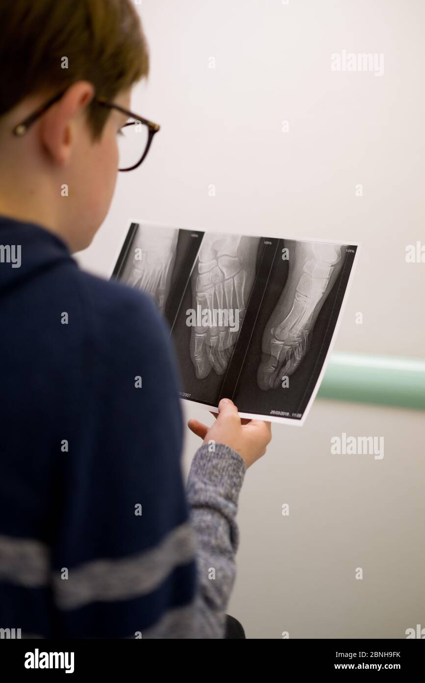 looking over the shoulder of a twelve year old boy who is looking at an X-ray in his hand of his foot with a fractured toe Stock Photo