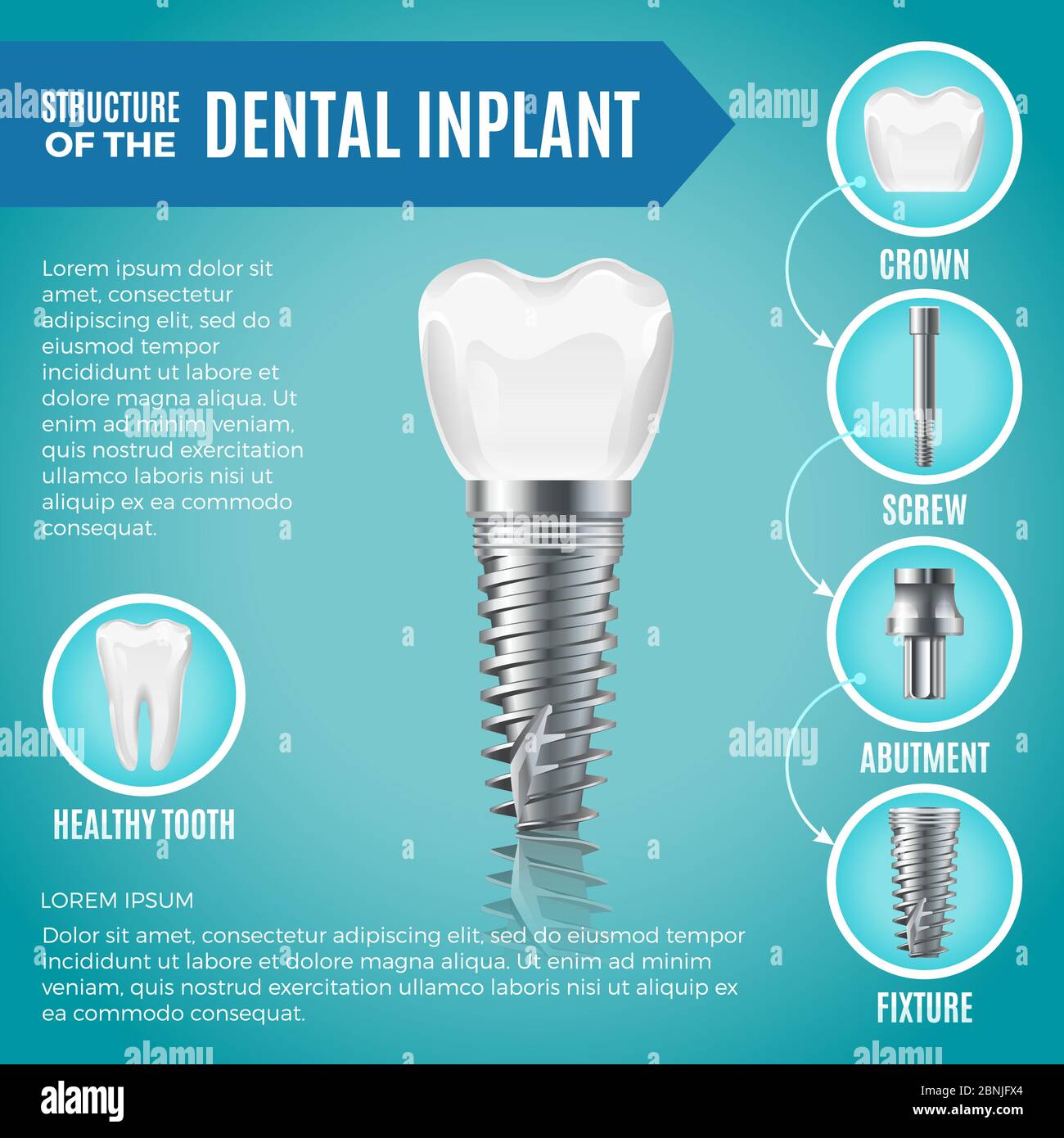 Teeth maquette. Structural elements of dental implant. Infographic for ...