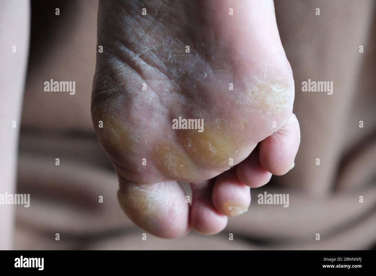 Foot fungus, tinea pedis, fungal infection.dermatology disease. leg fungus before treatment