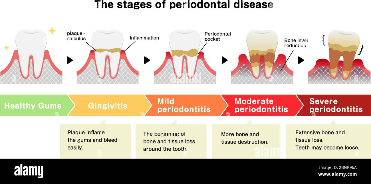 The stages of periodontitis disease vector illustration Stock Vector