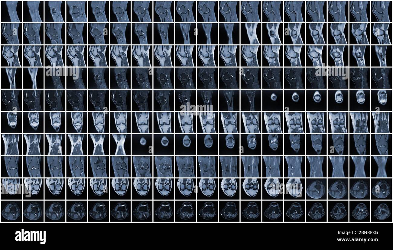 Complete Magnetic resonance imaging (MRI) of leftt knee Stock Photo