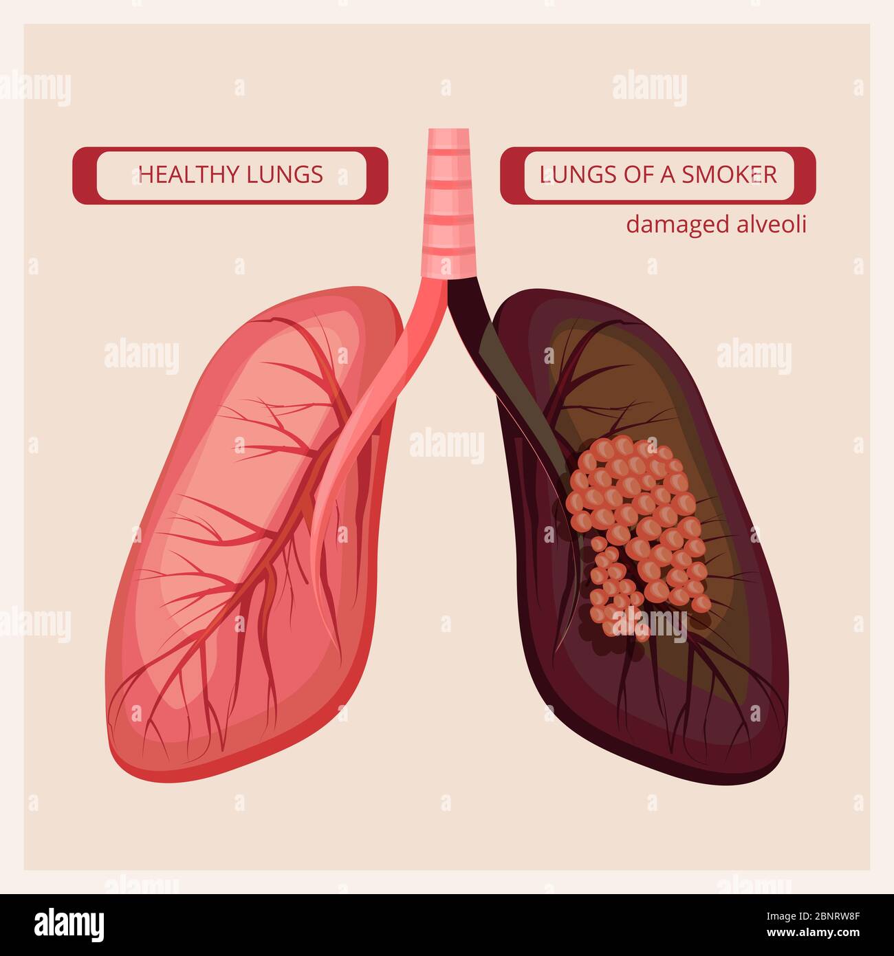 Smoker lungs. Smoke human damage lung cancer vector medical infographic  pictures Stock Vector Image & Art - Alamy