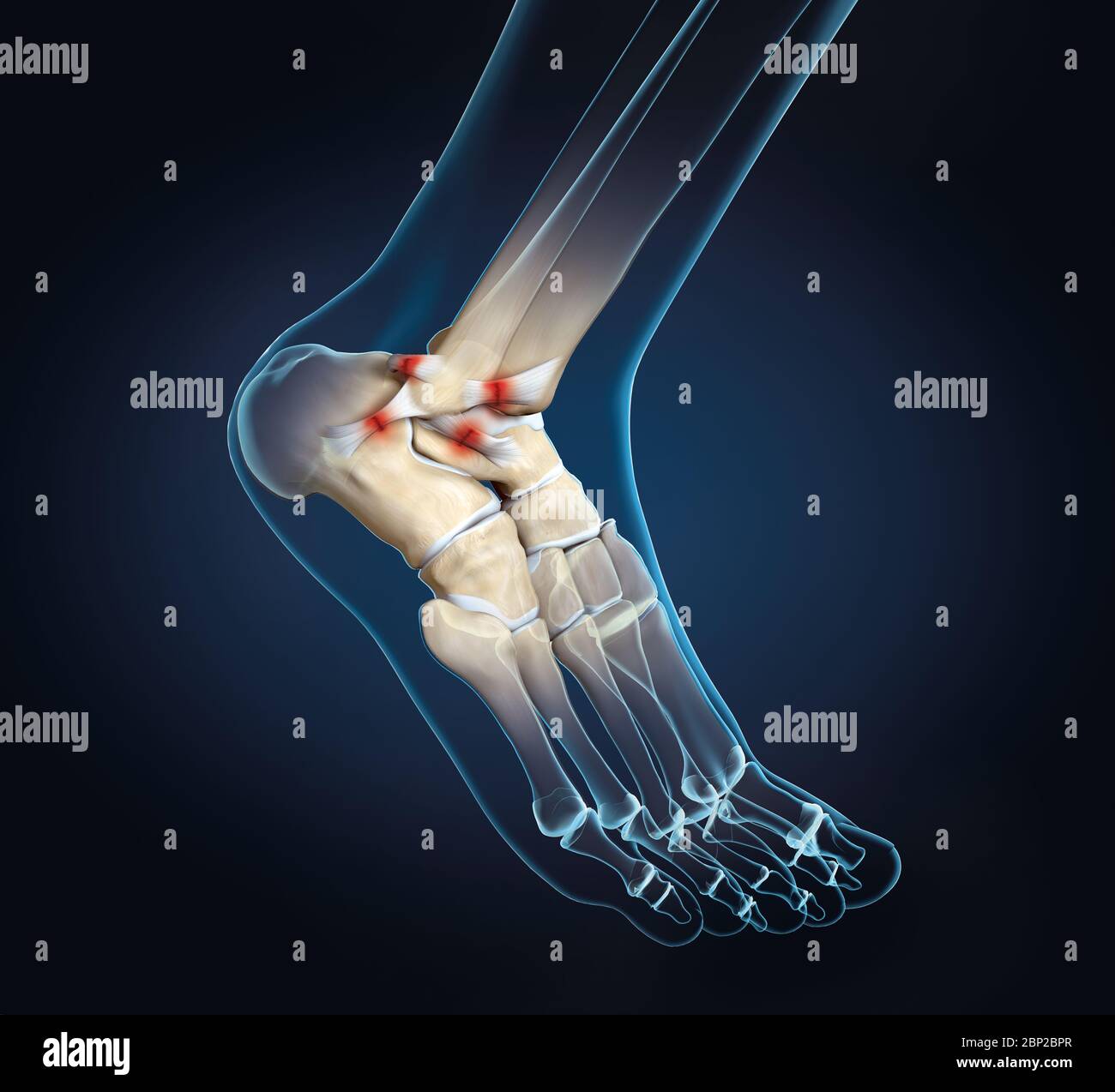 3D illustration showing rupture of a ligament in ankle joint Stock ...