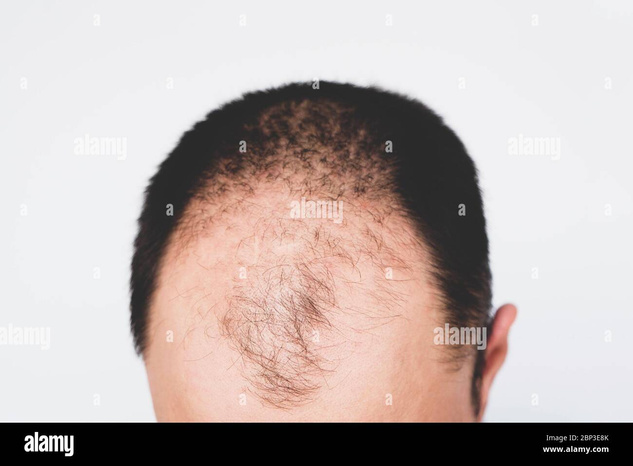 Male Pattern Hair Loss Problem Concept Baldness Alopecia In Males Stock Photo Alamy