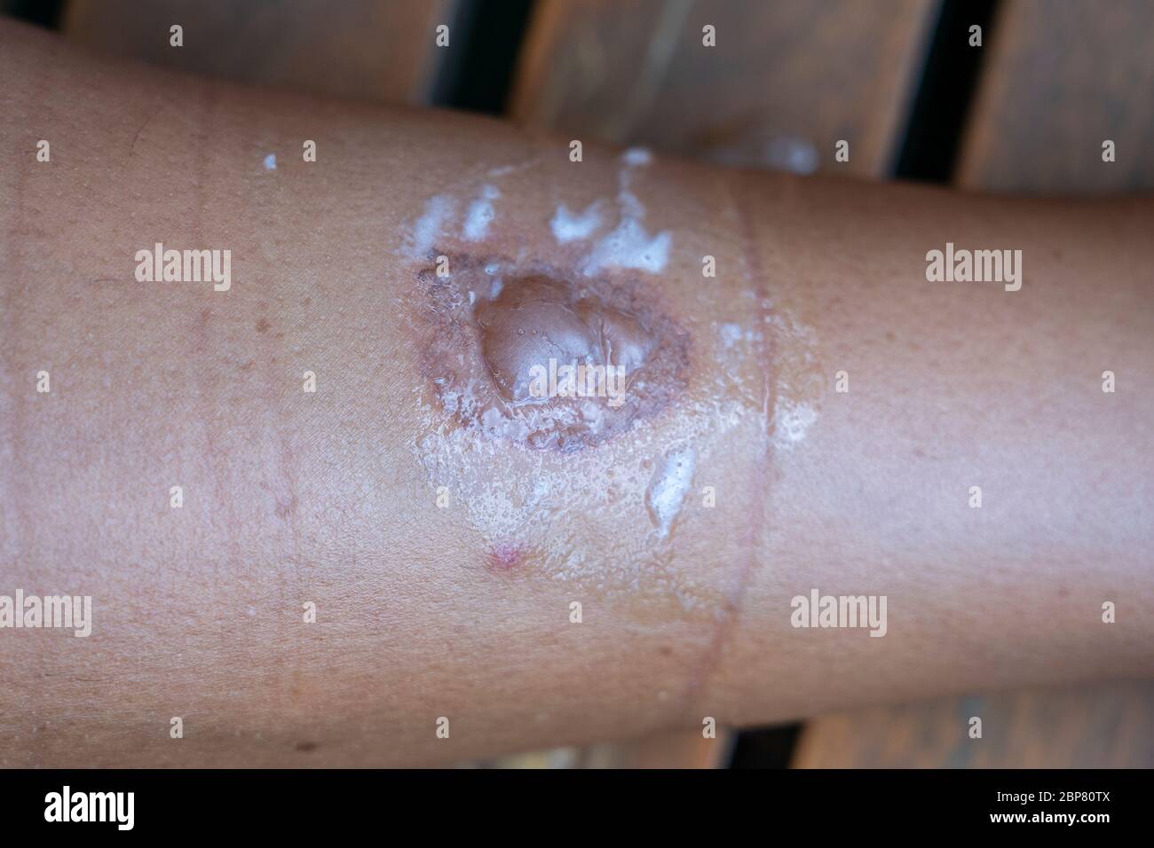 Skin burn on the leg of a young woman, close up. Injury was caused