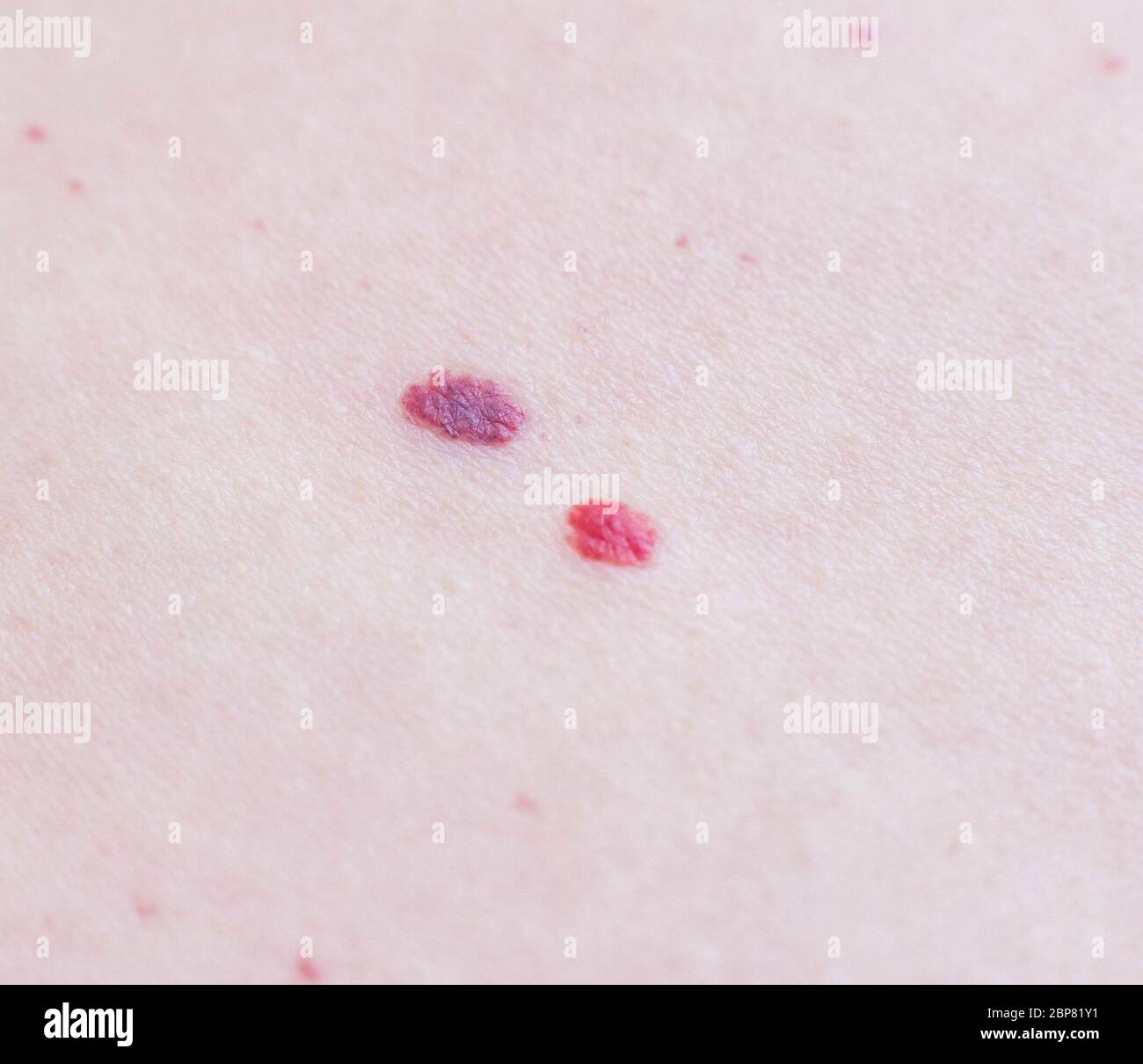 Two moles on the patient s skin, hemangioma, macro Stock Photo -