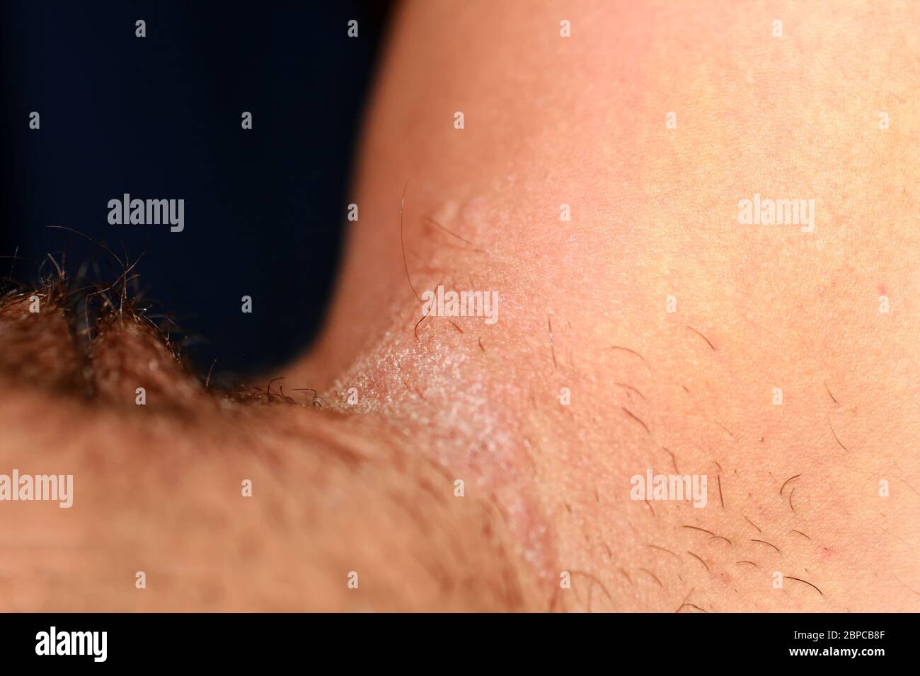 Fungal infection in the groin, Psoriasis, dermatitis, eczema. Stock Photo