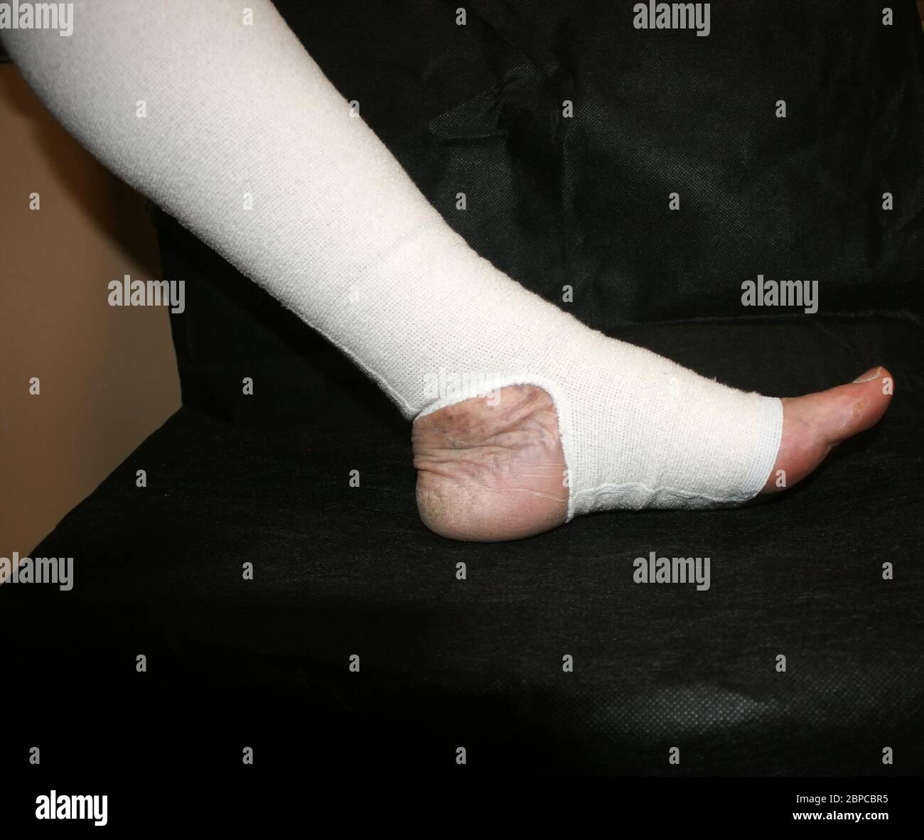 Leg. Varicose, veins. Phlebeurysm. Thrombophlebitis. Elastic bandage