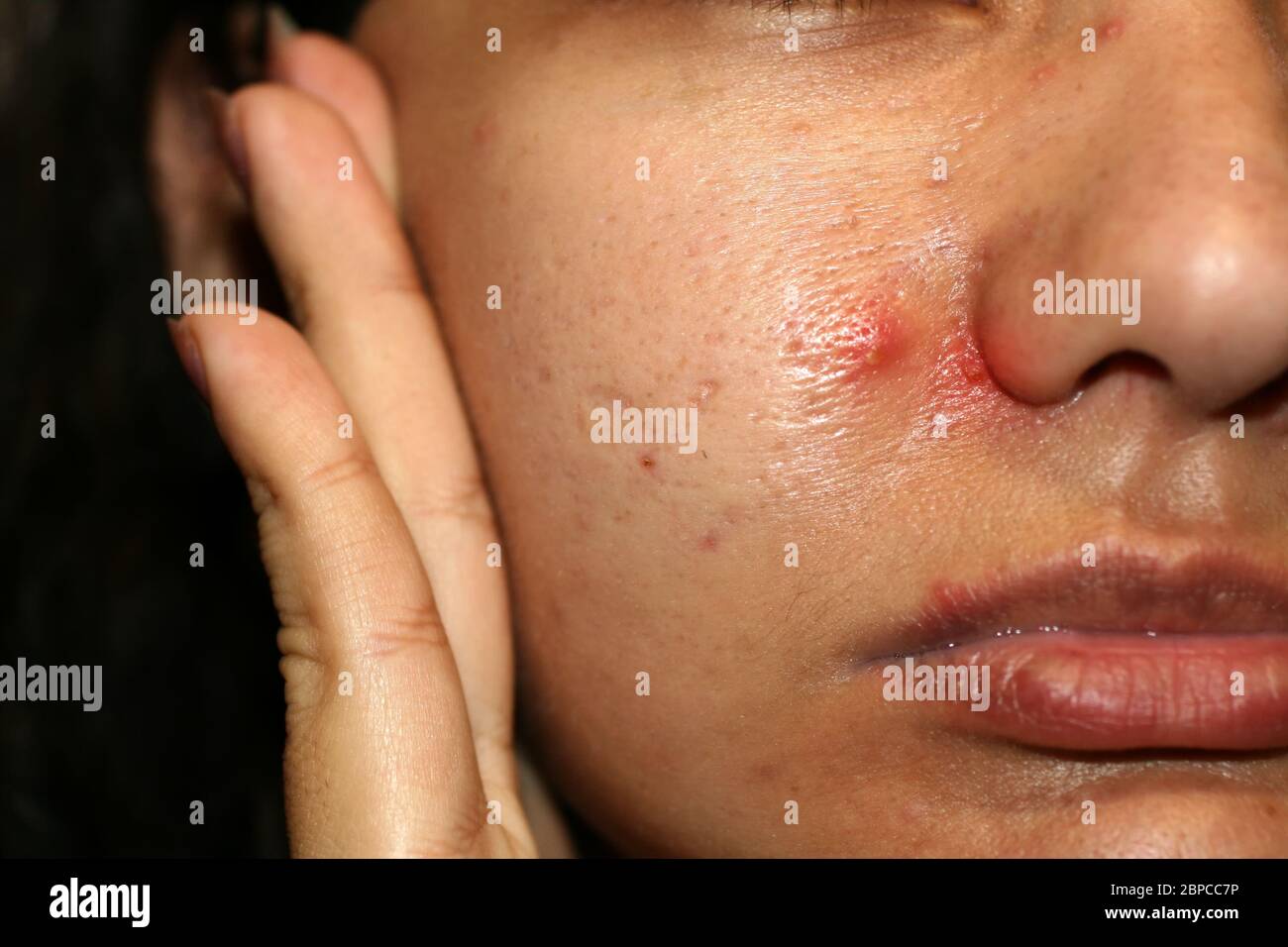 Inflammation on the skin of the face. Red pimples purulent. Acne. Keloid scars. Expanded pores Stock Photo